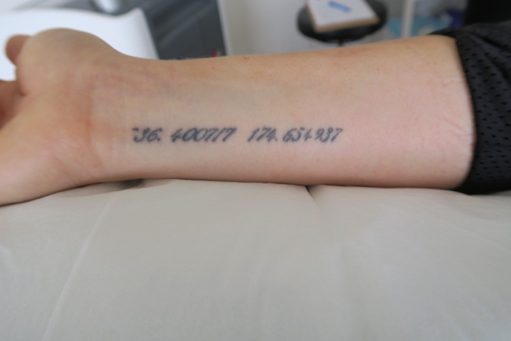 Naked Skin Laser Tattoo Removal Hamilton NZ
